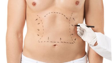 LIPOSCULPTURE