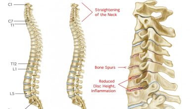 spinal fracture