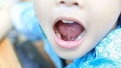 tongue tie removal