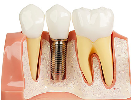 dental implants near me