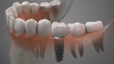dental implants near me