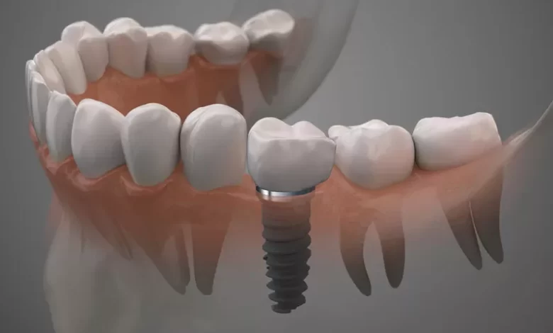 dental implants near me