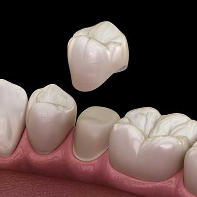 Dental Crown services